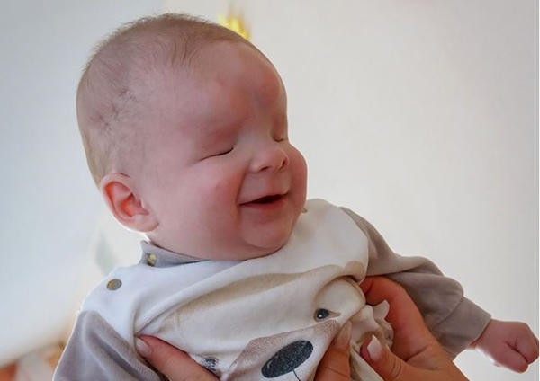 Bebê que nasceu sem olhos é colocado para adoção...
